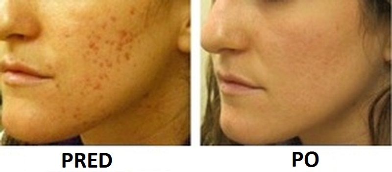 bradaviceapple-cider-vinegar-acne-does-it-work-how-to-remove-acne-scars